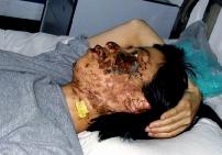 2004年5月7日，高蓉蓉遭受持續點擊，臉上是電燒灼傷。照片是受傷10天後拍攝的。