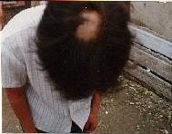 圖：李秀文的頭髮被惡警賈寶臣撕掉一大把