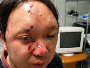 二零零六年二月八日美國法輪功學員李淵在亞特蘭大家中遭持槍歹徒襲擊，臉上縫了十五針