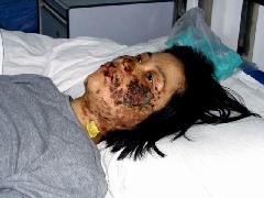 高蓉蓉2004年5月7日被惡警電擊灼傷。照片是受傷10天後拍攝的。
