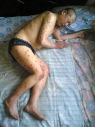 潘本余在泰來監獄被迫害得腹部水腫，不能進食；身體多處有煙頭燙和疥的痕跡。