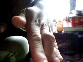 柳志梅左手中指已殘疾，骨節粗大，嚴重彎曲變形，無法伸直。據業內人士分析，可能是柳志梅遭受長期注射毒針所致。