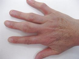 注射毒針的後遺症：胡克玲手指的骨節腫大