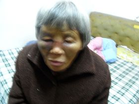 王柳珍的鼻樑被監控她的惡徒打斷，雙眼被打得青腫，睜不開。