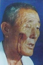 付文慶的老父親臉上留下疤痕
