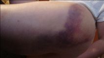 腿傷被打紫