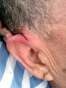 李洪奎的右側耳部有一長三釐米左右縱向豁裂傷口