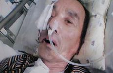 李德成被大連南關嶺監獄迫害的左側臉已萎縮，左眼塌陷失明，腿部嚴重受傷