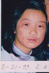 '圖1：照片攝於一九九九年二月，長達四年的皮炎還相當嚴重'