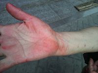圖3右手被強行按印泥並被掐成瘀傷