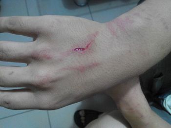 圖2：李宗澤被手銬銬出的傷痕