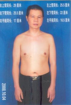 岳陽孫平華被酷刑折磨後，左手臂肌肉萎縮