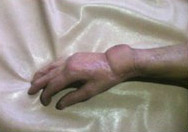 圖1：一塊肚皮植在手腕上