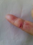 '龐繼紅被割開的手指傷口'