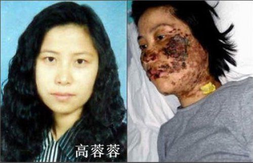 法輪功學員高蓉蓉被中共警察電擊前後對比照片。
