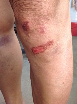 雷安祥遭警察毆打，兩腿被打得紅腫、青紫