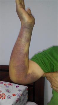 高國慶的妻子被扭傷的手臂