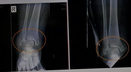 '圖2：王久春女士2015年11月7日的踝關節X光片（左）與同年12月4日的X光片（右），對比可以看出，車禍3週後骨折處已有癒合趨勢。'