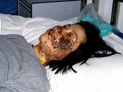 '高蓉蓉2004年5月7日被酷刑折磨，臉上是電燒灼傷。照片是受傷10天後拍攝的。'