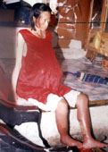 '吳玲霞被綁架進佳木斯勞教所遭迫害導致肝硬化腹水和雙下肢潰爛的照片'