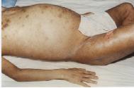 肖勁松被迫害得骨瘦如柴，腹部、大腿根部腫大。