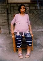 李陽芳被四川省資中楠木寺女子勞教所折磨得骨瘦如柴，腹部、下肢腫脹