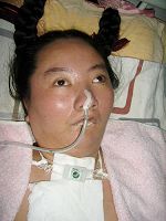 李慧琪被迫害成全身癱瘓，氣管被切開，靠插管維持呼吸的照片