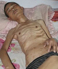 徐大為被瀋陽東陵監獄迫害得骨瘦如柴、身上有多處電擊印痕，臀部皮膚壞死。