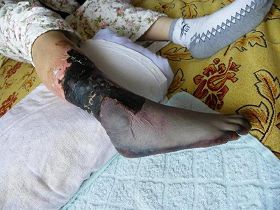 被注射毒針後宋會蘭的右腿小腿、腳變黑、壞死