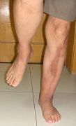 老張痊癒後兩張左腿單腿站立的照片