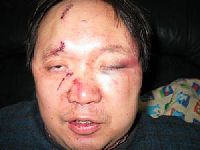 李淵博士，2月8日在家裏遭持槍歹徒襲擊，臉上縫了15針。