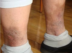 證據照片：初立文被鐵夾板夾雙腿後腿上傷痕