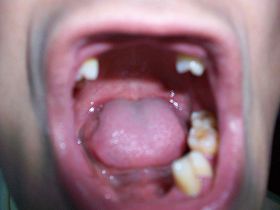 圖為張惠強大部份牙脫落後的口腔。