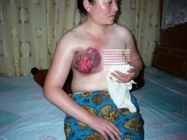 法輪功學員王雲潔，她的乳房被長時間電擊，致使整個乳房潰爛
