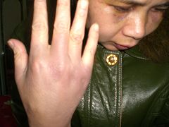 在洗腦班，楊蘭珍的手被打腫