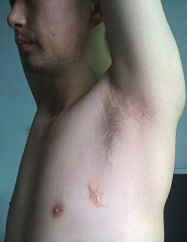 張志強2001年5月在勞教所被吊打燙傷腋窩傷疤，2015年6月手機拍照