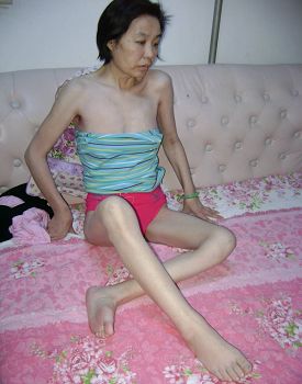 吳國輝被迫害得骨瘦如柴（上圖是從監獄接回後3天拍攝的照片）