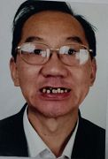 油畫專家韓以明的牙齒被打斷幾顆