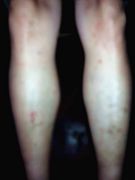 六年前雙腿被酷刑折磨後留下的疤痕