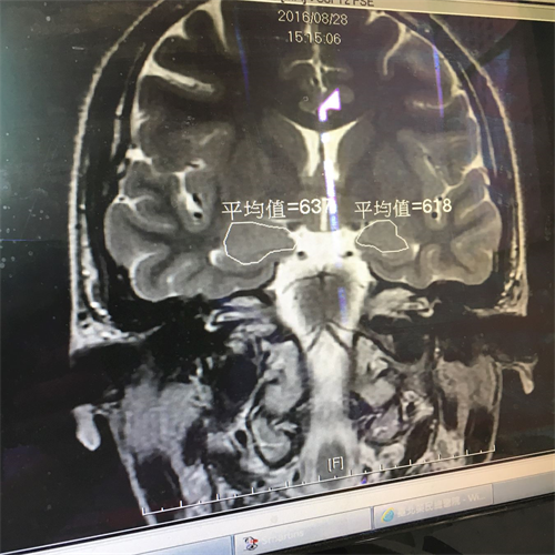 '圖2：醫院做核磁共振檢查顯示「腦部杏仁核腫大」。'