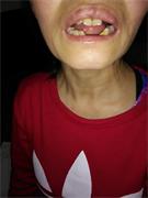 王素梅被迫害牙齒掉了四顆，還有七顆活動。