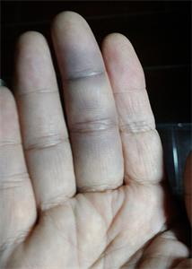 圖1：王曉玲右手中指淤傷