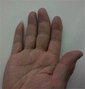 圖3：王曉玲右手手指變形。