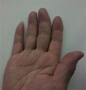 '圖2：王曉玲右手手指變形'