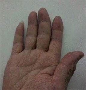 '圖2：王曉玲右手手指變形'