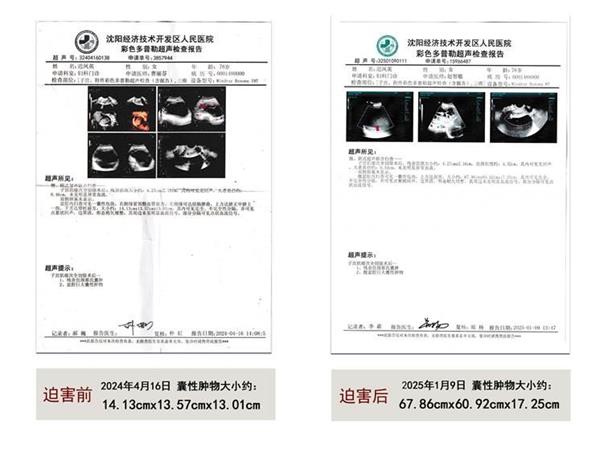 '【腹盆腔囊腫物大小是迫害前的近三十倍】'