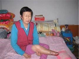 '宋會蘭被迫害致殘、右腳壞死脫落'